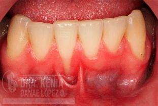 MICROCIRUGÍA PLÁSTICA PERIODONTAL