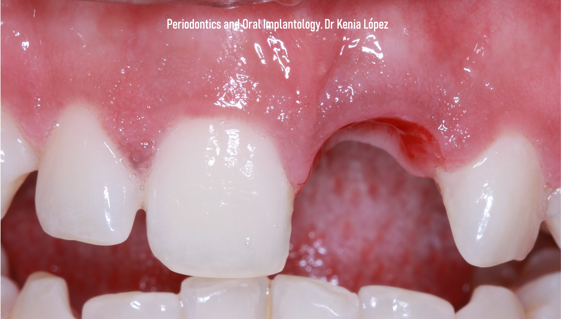 IMPLANTOLOGÍA DENTAL