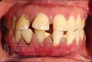 DIAGNOSTICO Y TRATAMIENTO DE ENFERMEDADES PERIODONTALES