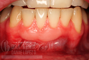 MICROCIRUGÍA PLÁSTICA PERIODONTAL