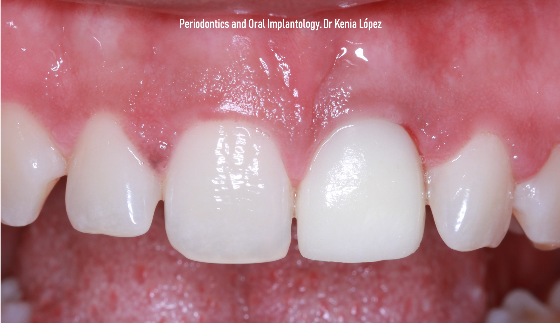 IMPLANTOLOGÍA DENTAL