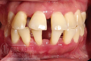 DIAGNOSTICO Y TRATAMIENTO DE ENFERMEDADES PERIODONTALES